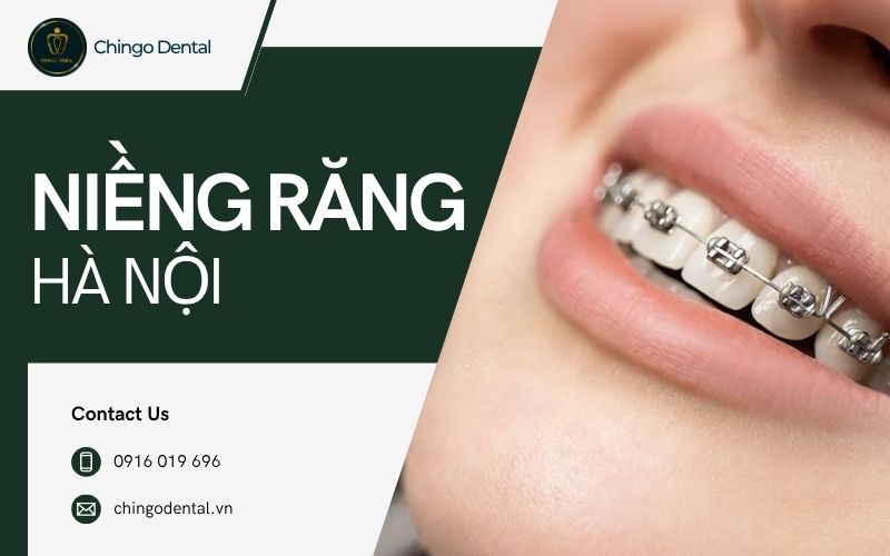 bảng giá niềng răng hà nội