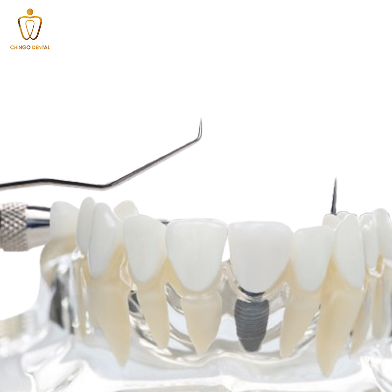bảng giá trông răng implant hà nội