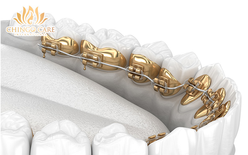 chi phí niềng răng mắc cài mặt trong