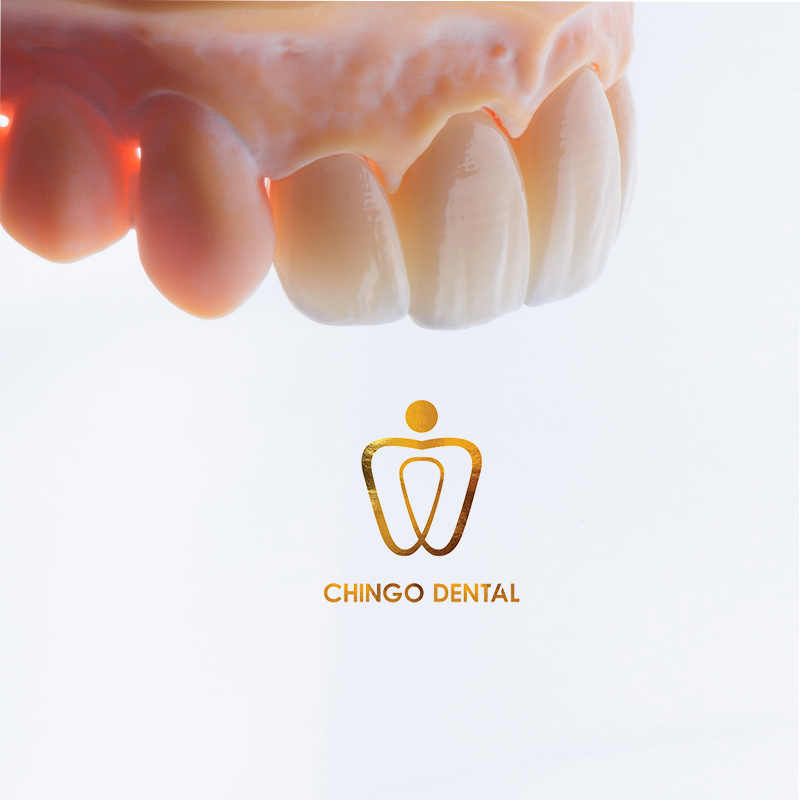 dán sứ veneer hà nội