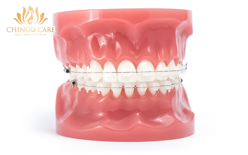 niềng răng mắc cài sứ bao nhiêu tiền