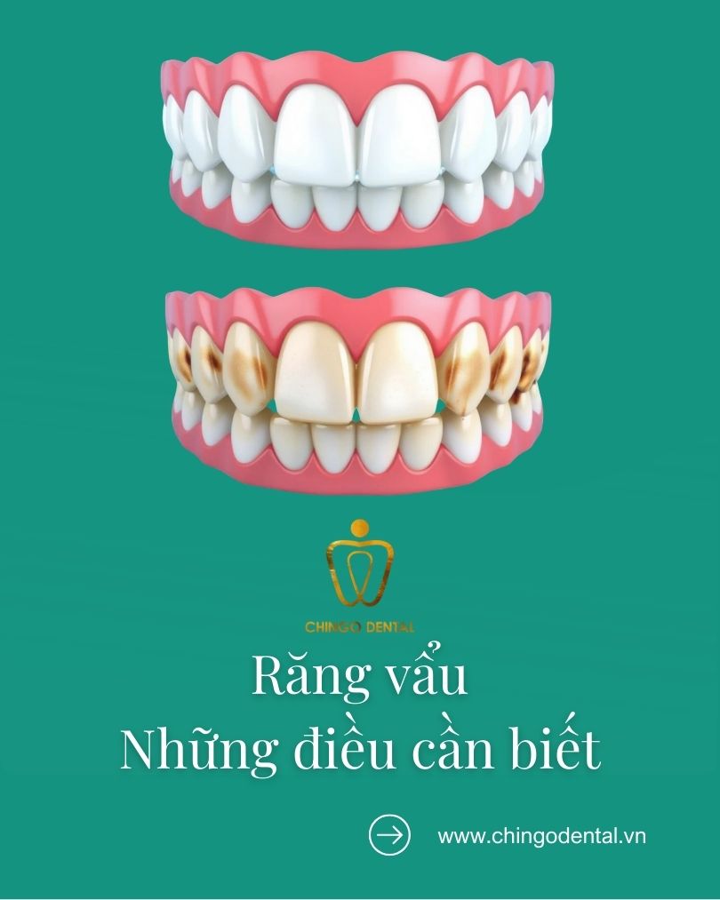 răng vẩu là gì