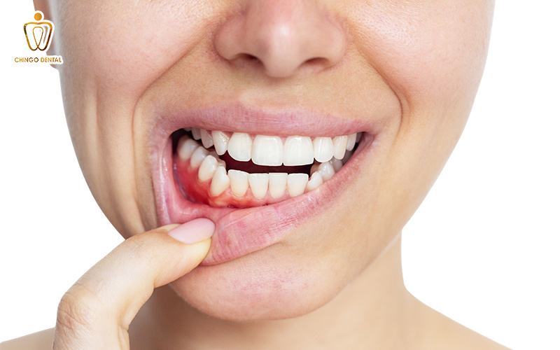 sưng nướu răng trong cùng hàm dưới