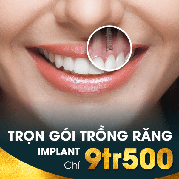 trong-rang-implant-chingo.png