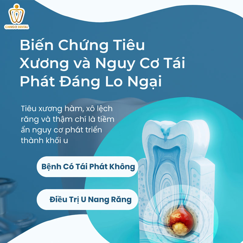 Nang Thân Răng Là Gì? Biến Chứng Tiêu Xương và Nguy Cơ Tái Phát Đáng Lo Ngại 51 nâng khớp răng là gì