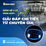 Răng Số 4 Là Răng Nào? Có Nên Nhổ Để Niềng Không? - Những Lưu Ý "Sống Còn" Bạn Cần Biết có nên nhổ răng số 4 để niềng không