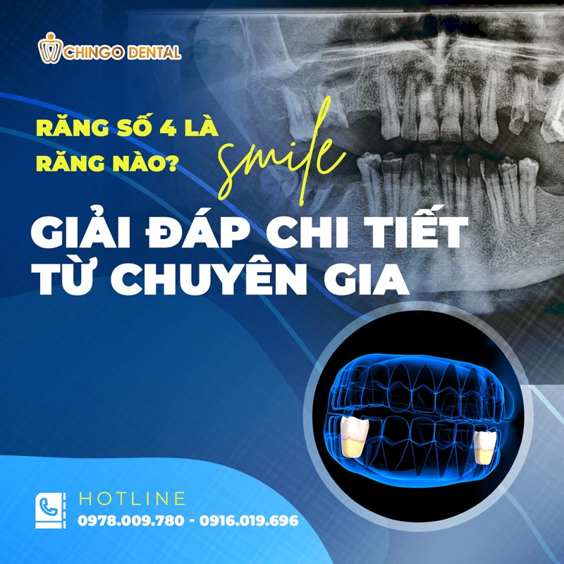 Răng Số 4 Là Răng Nào? Có Nên Nhổ Để Niềng Không? - Những Lưu Ý "Sống Còn" Bạn Cần Biết 28 có nên nhổ răng số 4 để niềng không