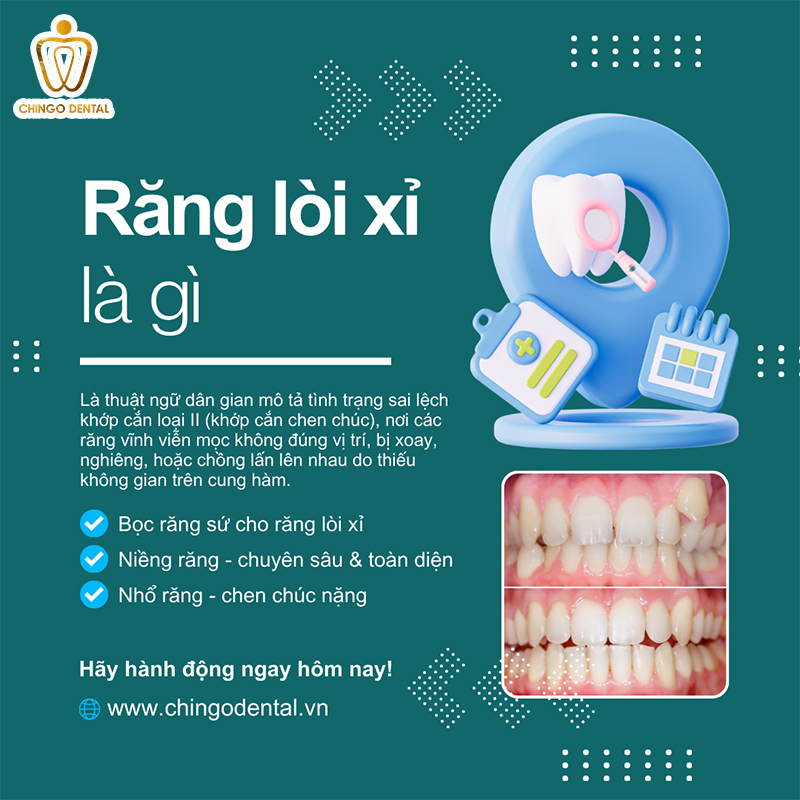 Răng Lòi Xỉ Là Gì? 99% Người Gặp Phải Đã Sửa Được Với Cách Này! 47 hình ảnh răng lòi xỉ