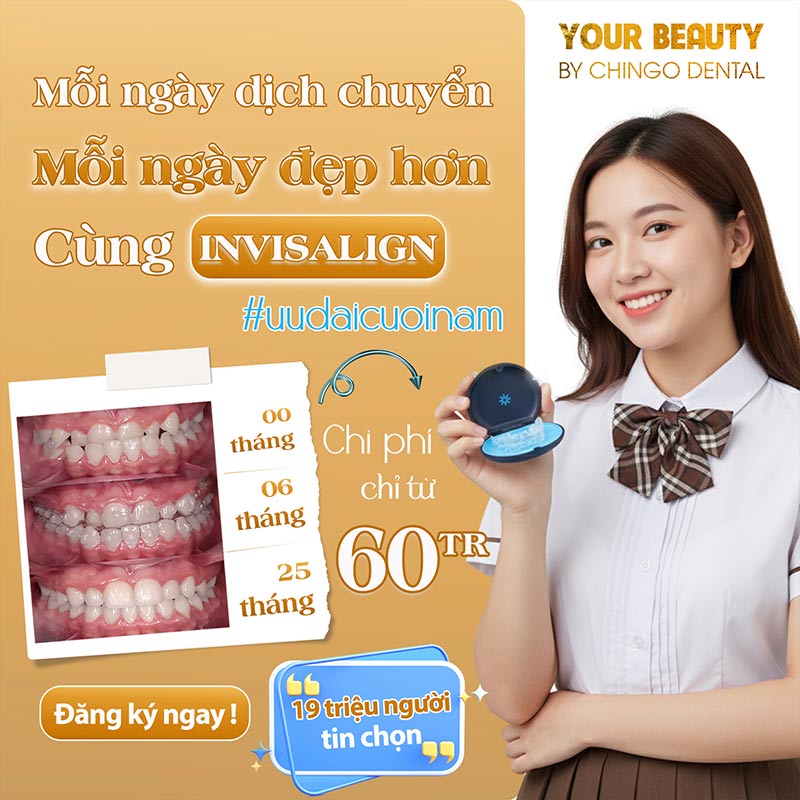 Niềng Răng Invisalign 41 quy trình niềng răng invisalign