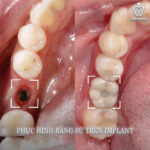 mất răng lâu năm có trồng implant được không