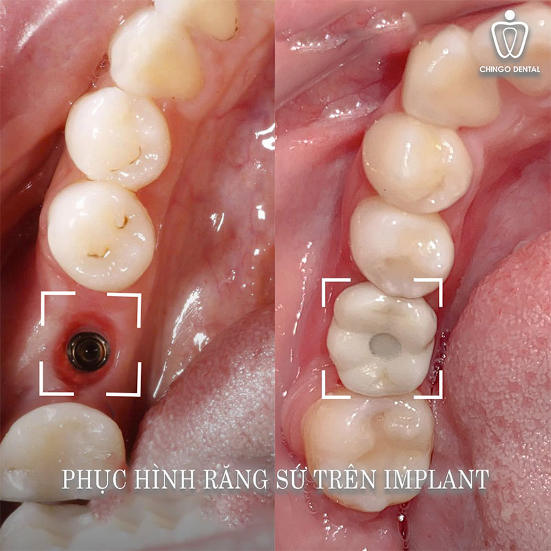 mất răng lâu năm có trồng implant được không