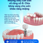 Răng Số 6 Có Thay Không? Sự Thật Về Chiếc 'Răng Cốt Lõi' Và Giải Pháp Phục Hồi Bền Vững - Cẩm Nang Sức Khỏe Cho Bạn nhổ răng số 6