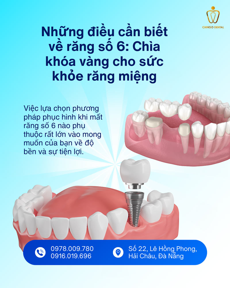 Răng Số 6 Có Thay Không? Sự Thật Về Chiếc 'Răng Cốt Lõi' Và Giải Pháp Phục Hồi Bền Vững - Cẩm Nang Sức Khỏe Cho Bạn 21 nhổ răng số 6