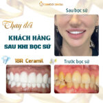 cách tẩy trắng răng ố vàng