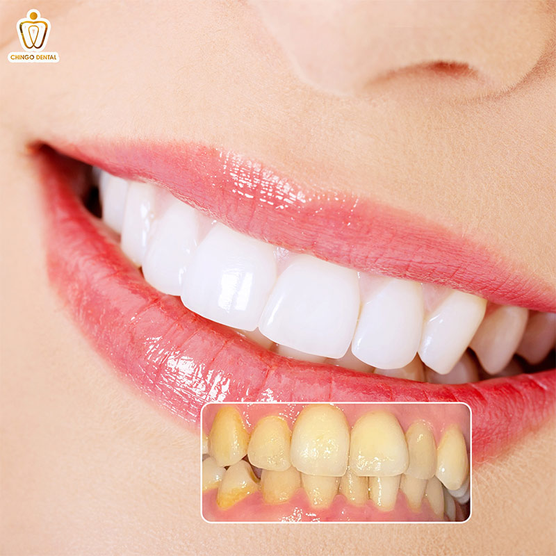 răng bị ố vàng