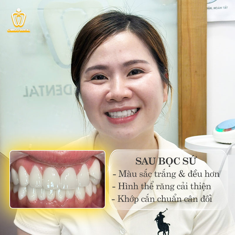 răng khểnh đẹp