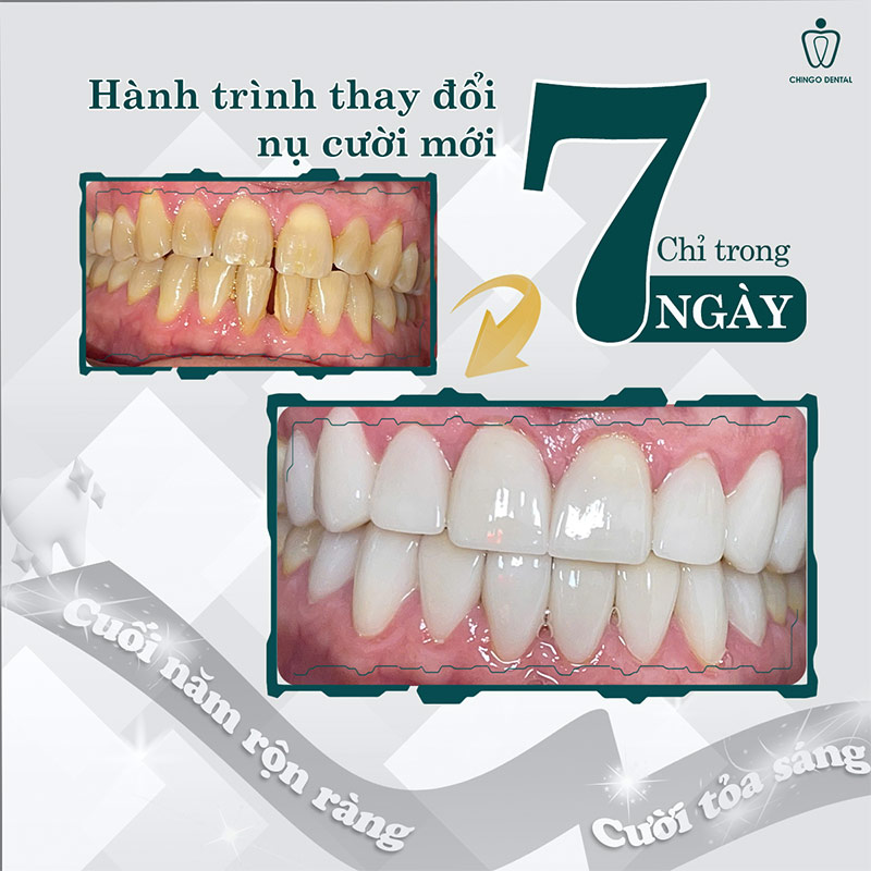 răng sứ bị đổi màu