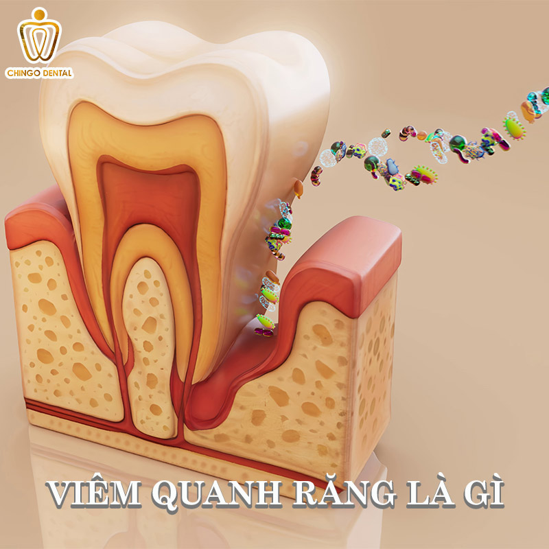 Viêm quanh răng là gì?