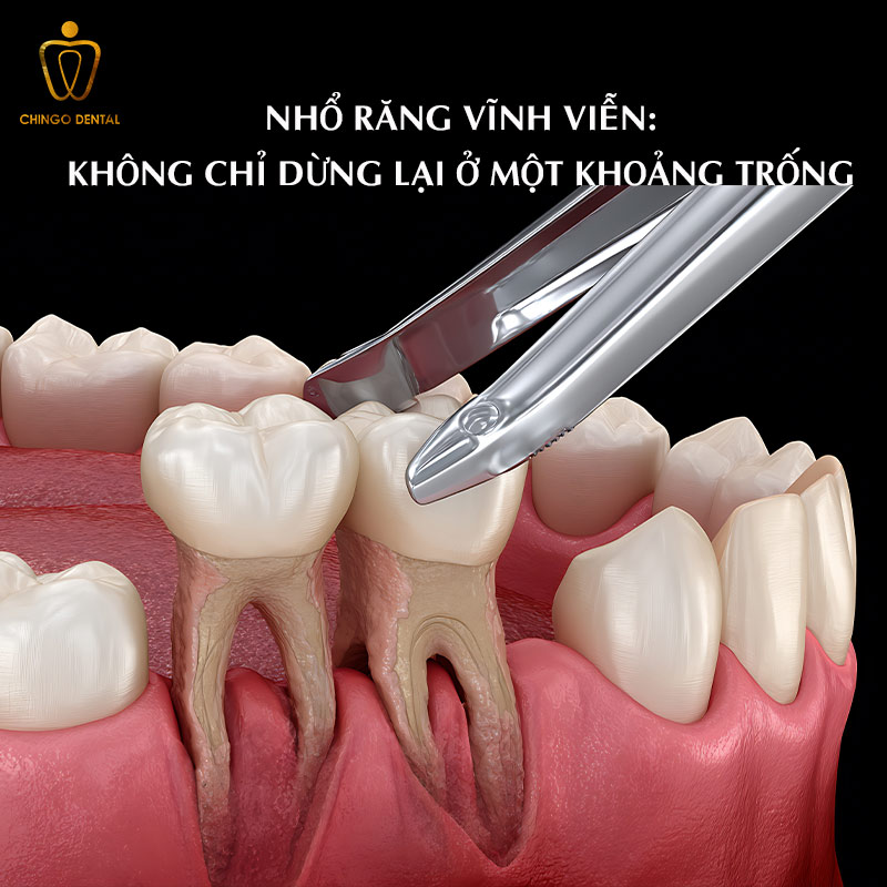 Khi nào phải nhổ răng vĩnh viễn?