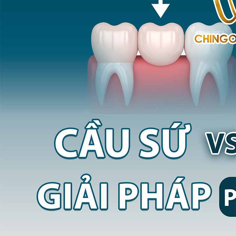 nho rang vinh vien bi sau