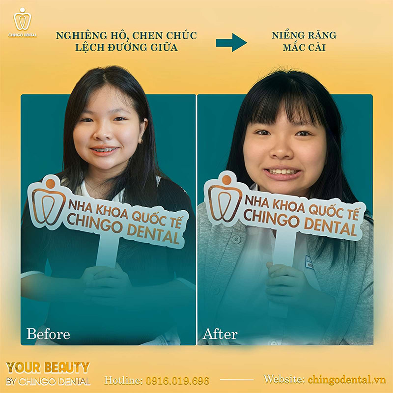 niềng răng uy tín Đà Nẵng