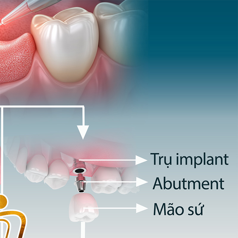 quy trinh nho rang vinh vien